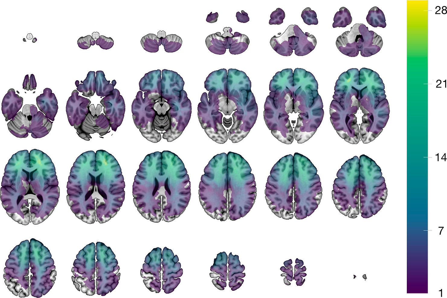 Lesion distribution map. Voxel-wise sum of the 221 modelled lesions overlaid on the SPM152 T1 template distributed with MRIcroGL. The images are displayed in neurological convention (left is left).