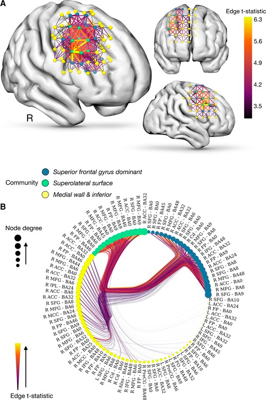 Network modelling of fluid intelligence. Network-based statistics identify a significant network associated reduced adjusted APM scores. 