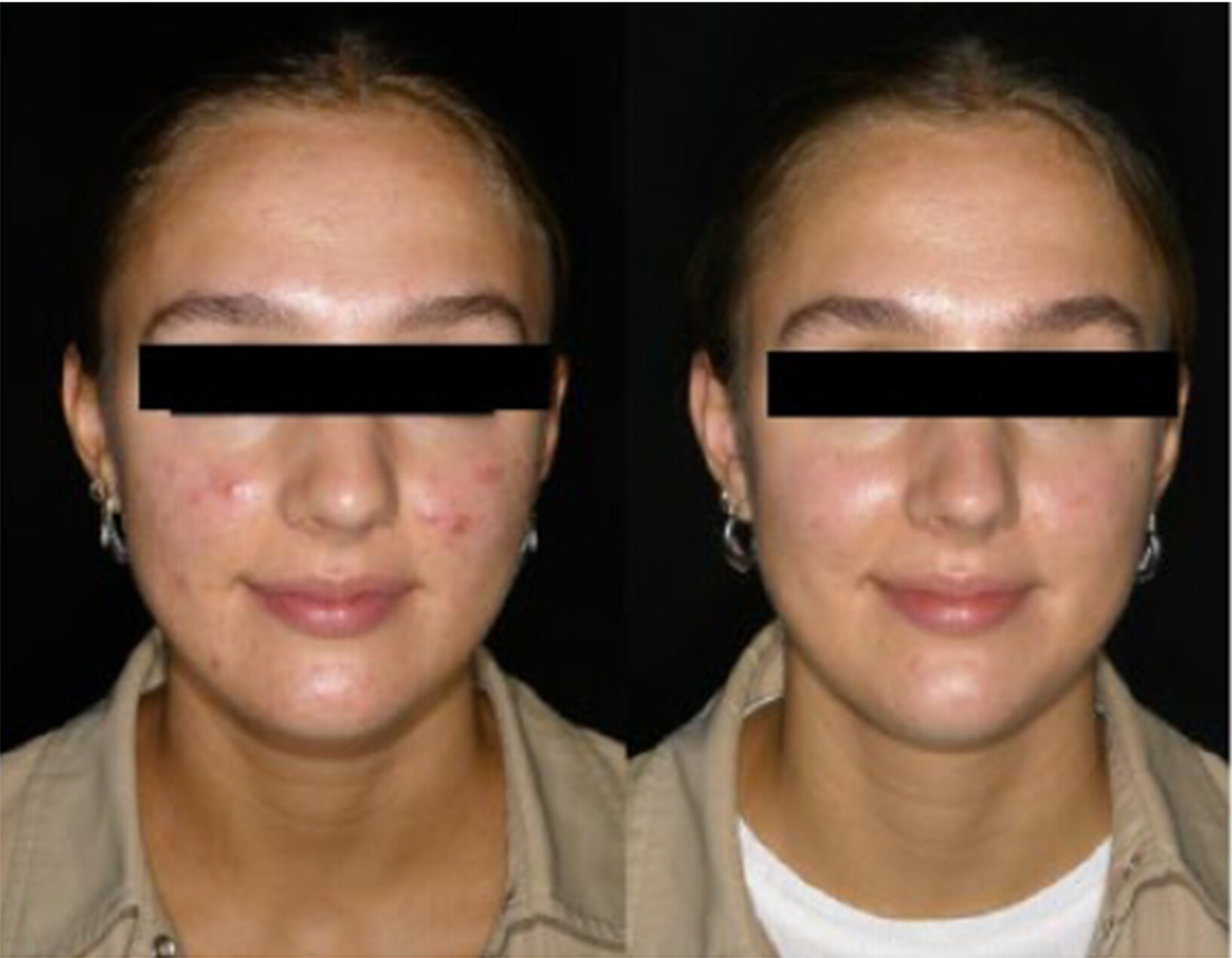 Comparison of clinical severity of three patients between V1 (left pictures) and V4 (right pictures).