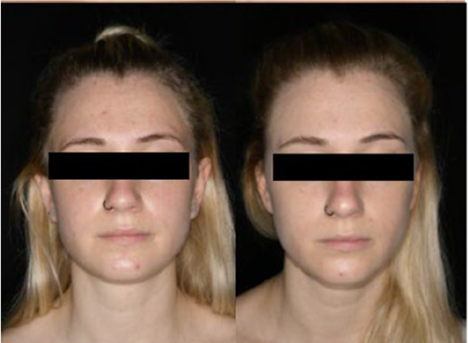 Comparison of clinical severity of three patients between V1 (left pictures) and V4 (right pictures).