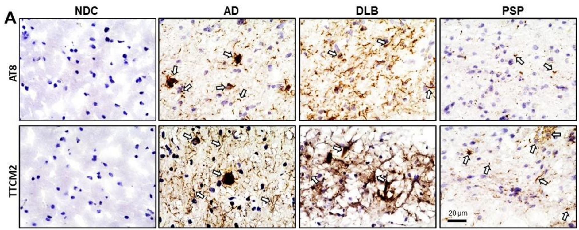 Representative images of TTCM2 and AT8 immunohistochemical (IHC) staining in fixed frontal cortex sections
from AD, DLB, PSP and NDC brain tissues.
