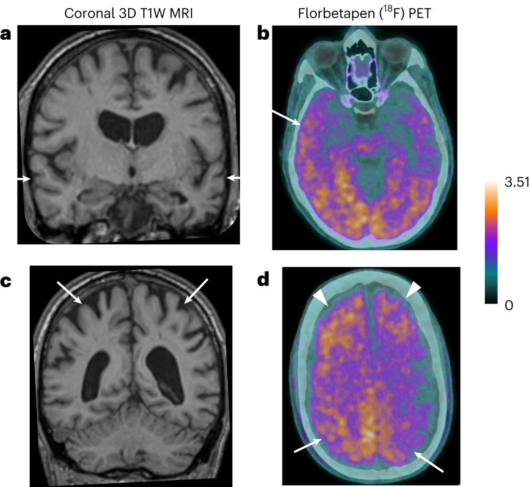 Magnetic resonance and amyloid-PET (18F-Florbetapen) images—case 3. High-resolution three-dimensional (3D) T1-weighted (T1W) magnetic resonance (MR) coronal image through the temporal lobes demonstrates volume loss within the temporal lobes bilaterally (arrows) and also marked central atrophy. 