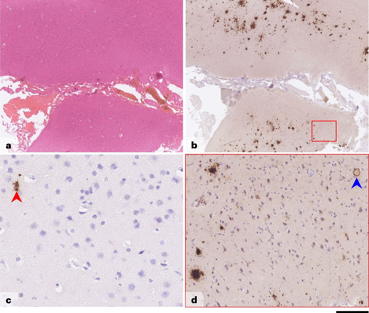 Brain biopsy—case 2. Images shown are from a left frontal lobe brain biopsy. 