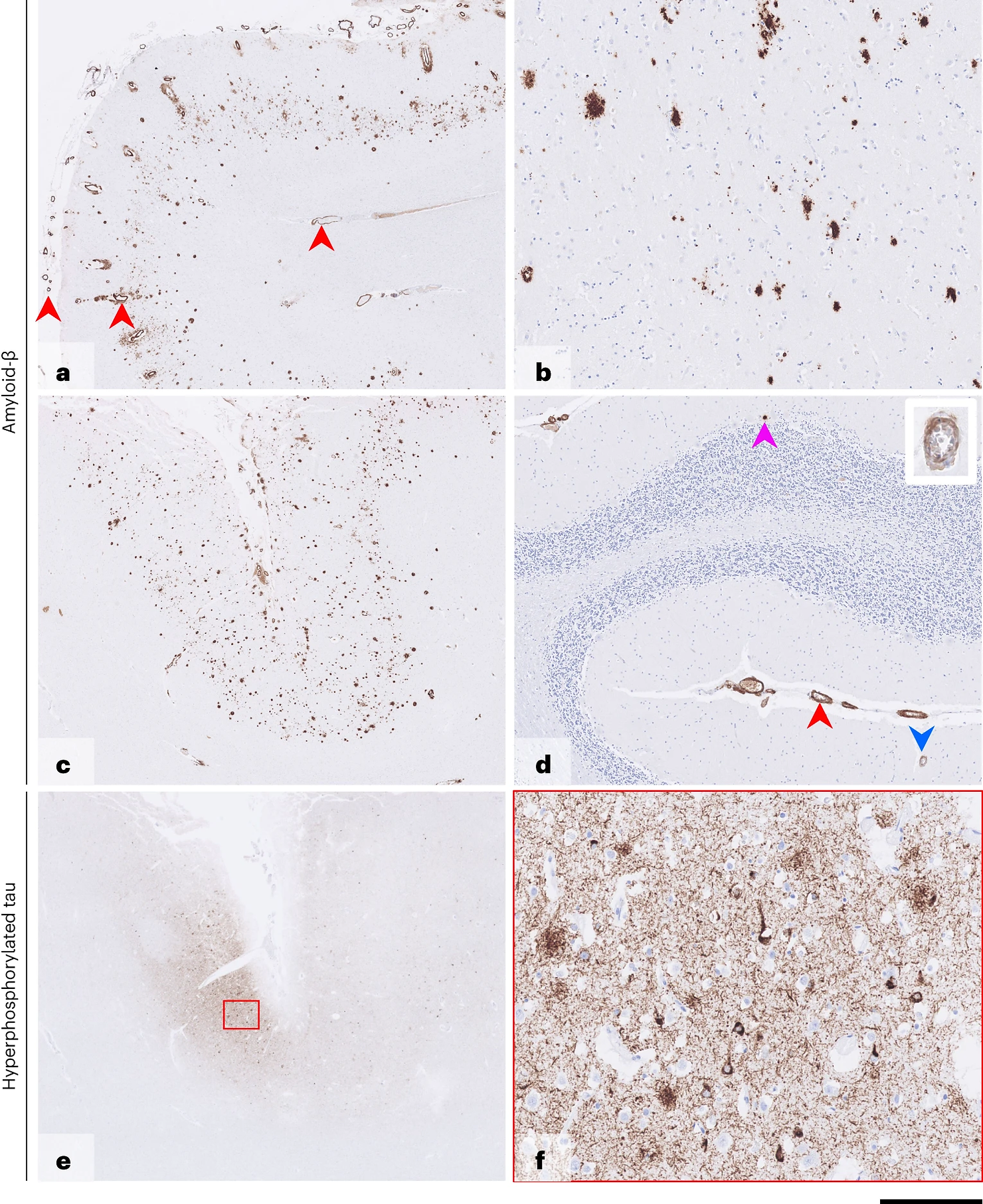 Postmortem brain tissue—case 1. Immunostaining for Aβ shows frequent parenchymal deposits in the cortex (a and c) and caudate nucleus (b), with rare, isolated deposits in the cerebellar cortex (d, pink arrowhead). 