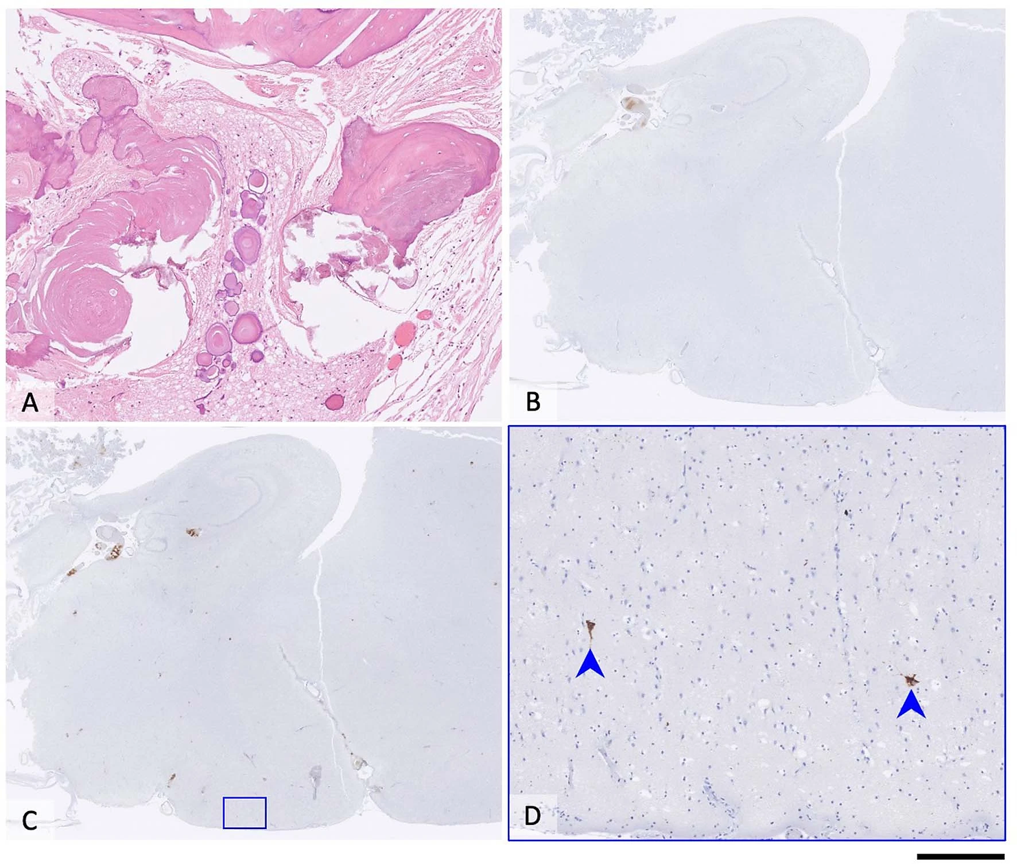 Post-mortem brain tissue, Case 2. Haematoxylin and eosin-stained preparation demonstrates extensively calcified and ossified adamantinomatous craniopharyngioma invading into the brain tissue, without any histological signs of malignant transformation. 
