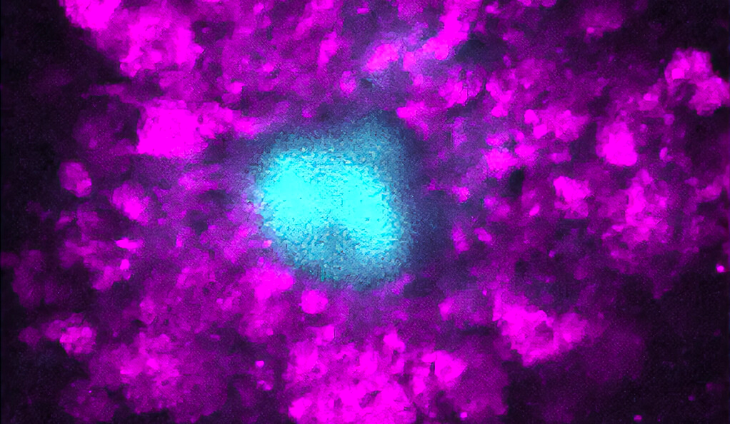 Swelling surrounding amyloid plaques (light blue) in Alzheimer’s patients may be a culprit in dementia symptoms.