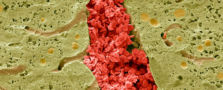 A scanning electron micrograph of a section through a vein in the liver, showing red blood cells surrounded by hepatocytes (green).