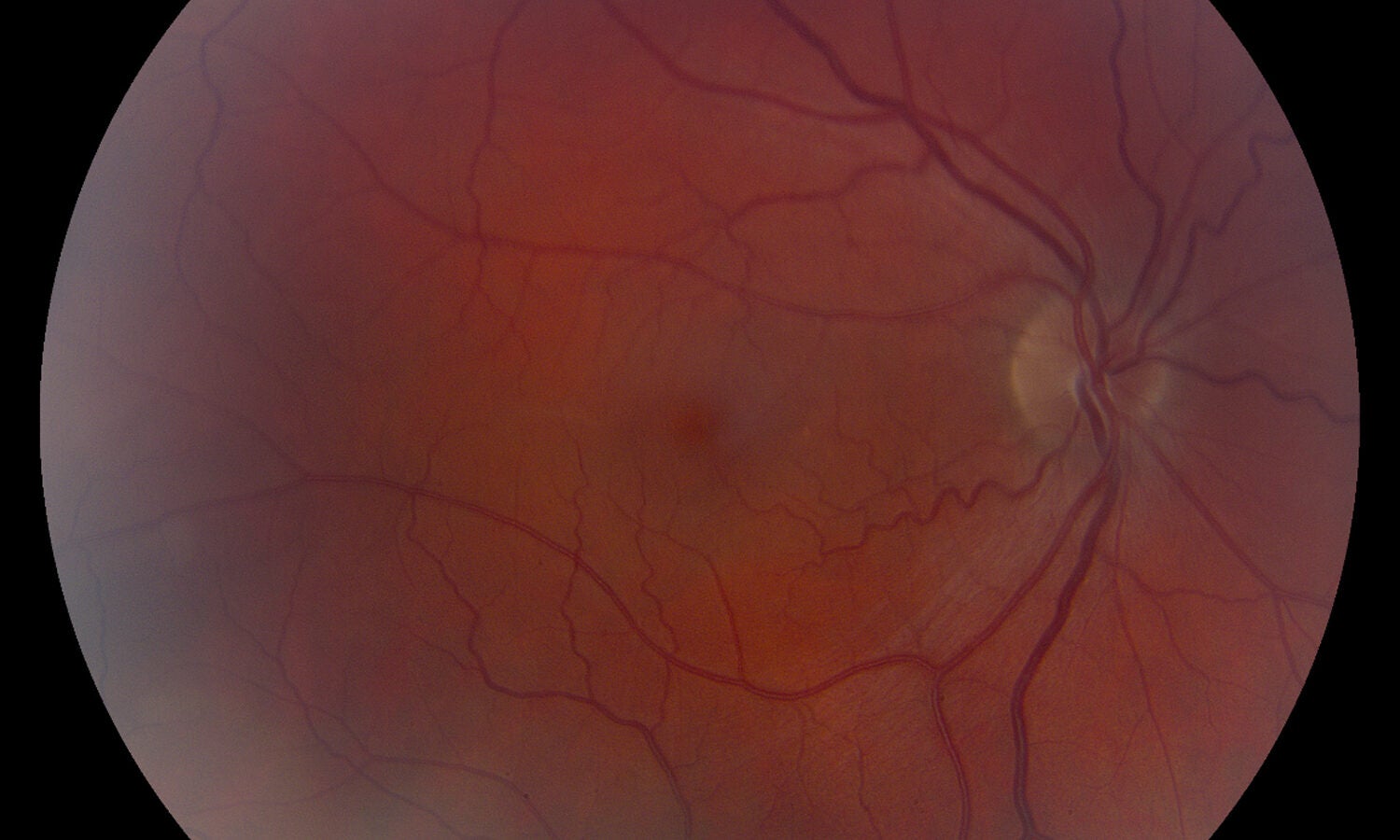 A view of nonarteritic anterior ischemic optic neuropathy, also known as an "eye stroke." 