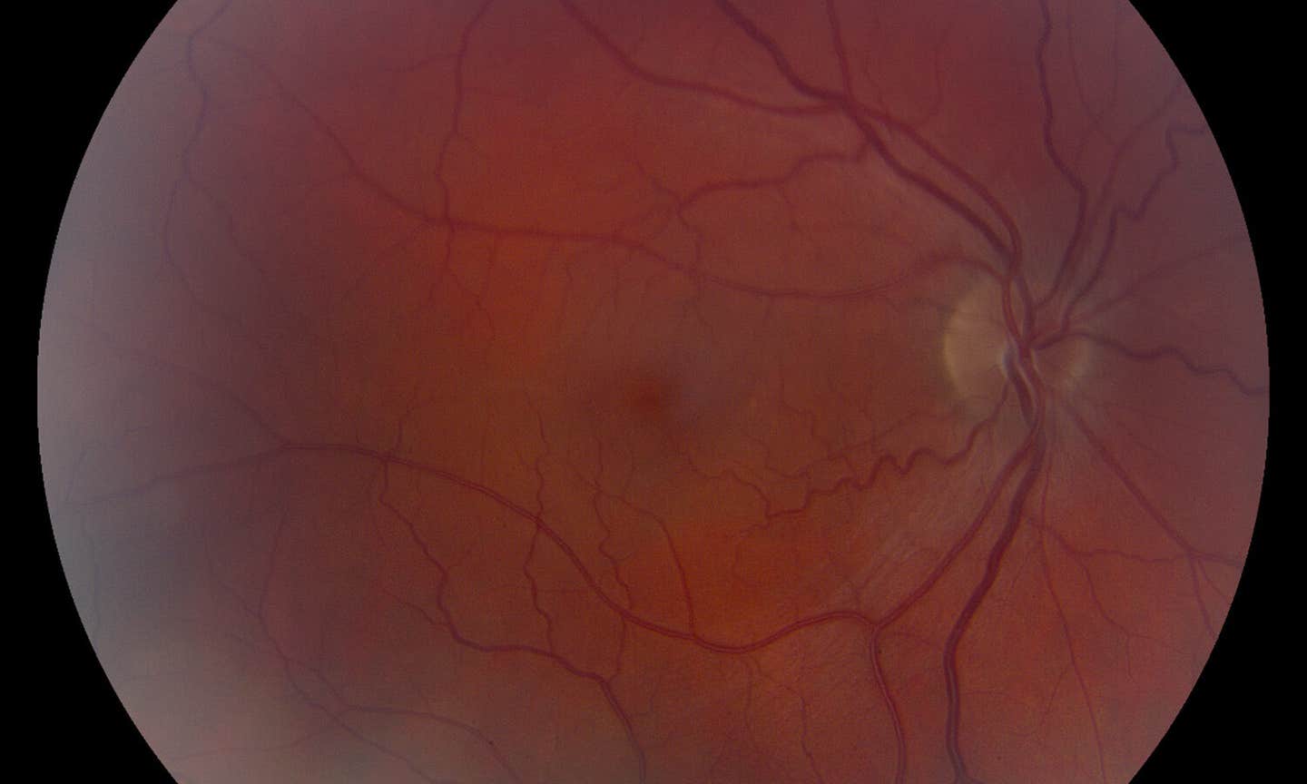 semaglutide eye linked to higher risk of vision problems, FDA data analysis shows Effect of semaglutide eye drops