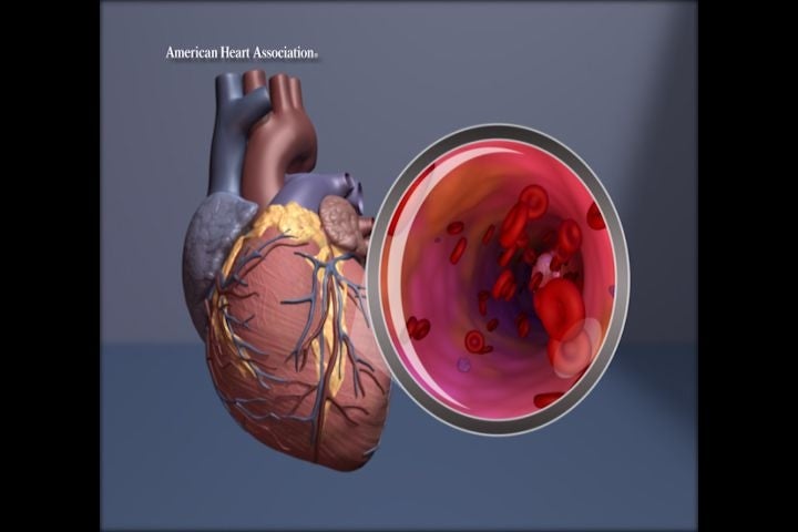 Heart illustration with magnification of the artery.

