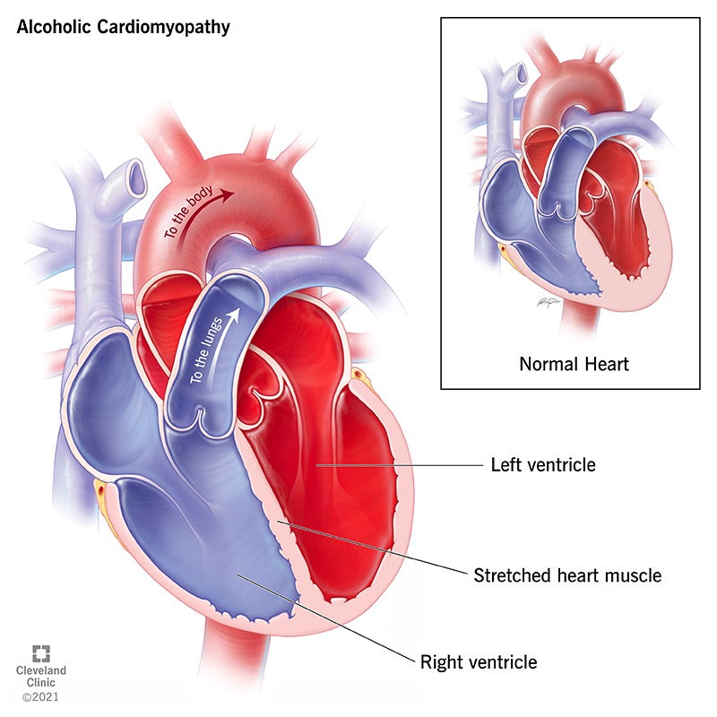 Alcohol-Induced Cardiomyopathy: