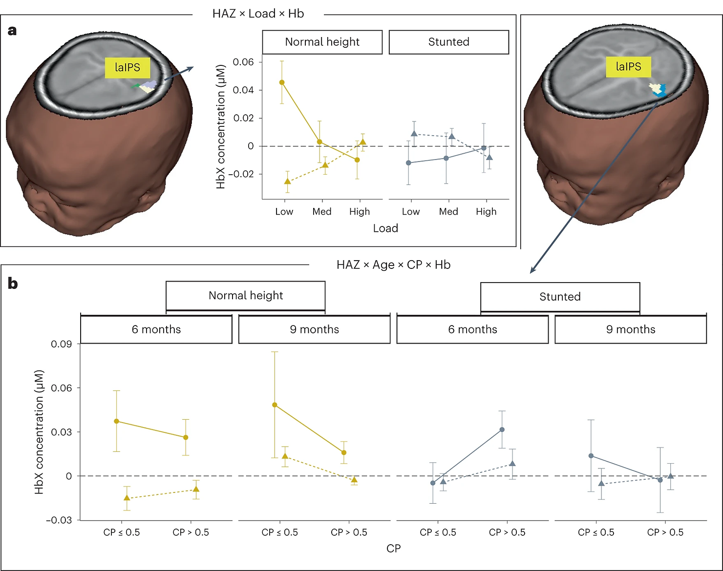 Brain image shows location of interaction between HAZ, load and chromophore (lavender), interaction between age and chromophore and overlap (white) in a superior cluster in laIPS. 