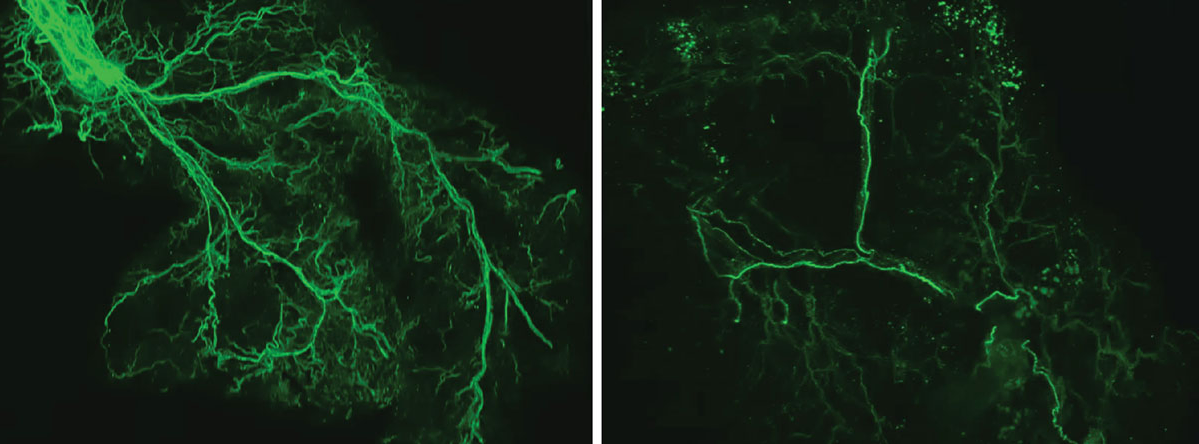 With age, the researchers found that the protein Ppp1r17 tends to leave the nucleus of the neurons, and when that happens, the neurons in the hypothalamus send weaker signals. With less use, the nervous system wiring throughout the white adipose tissue gradually retracts, and what was once a dense network of interconnecting nerves (left) becomes sparse (right). 