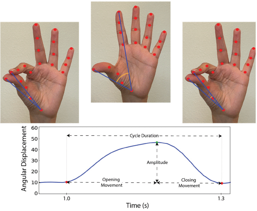 New video test uses AI to revolutionize Parkinson's disease treatment ...