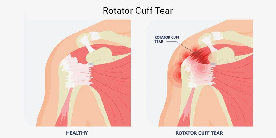 A rotator cuff tear occurs when the tendons – the fibrous connective tissues that link muscles to bones in the shoulder area are stretched further away from the upper arm bone. 
