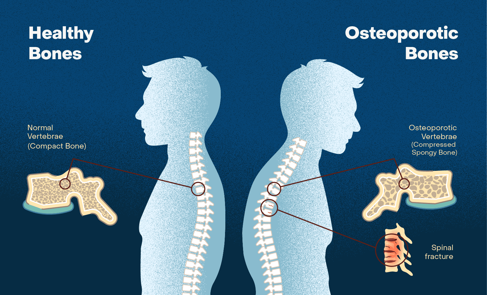 The research opens up new avenues for developing treatments that could help maintain bone integrity and reduce the risk of fractures as you age. 