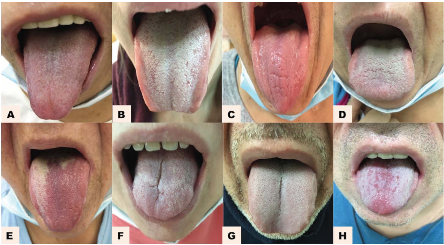 (A) Patient with mild severity of coronavirus disease: red tongue with no plaque; (B) Patient with mild severity of coronavirus disease: pale pink tongue with white plaque; (C) Patient with moderate severity of coronavirus disease: red tongue with no plaque; (D) Patient with moderate severity of coronavirus disease: pink tongue with grey plaque; (E) Patient with moderate severity of coronavirus disease: red tongue with yellow plaque; (F) Patient with severe coronavirus disease: pink tongue with white plaque; (G) Patient with severe coronavirus disease: pink tongue with white plaque; (H) Patient with severe coronavirus disease: red tongue with white plaque.