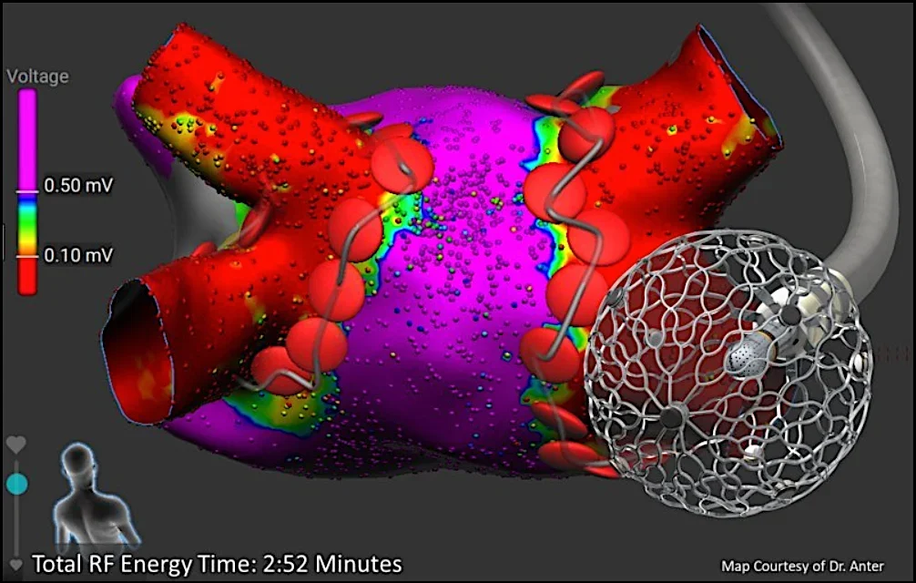 Both pulsed field energy systems have been approved to treat AFib through pulmonary vein isolation and have demonstrated similar efficacy to traditional radiofrequency ablation in clinical trials