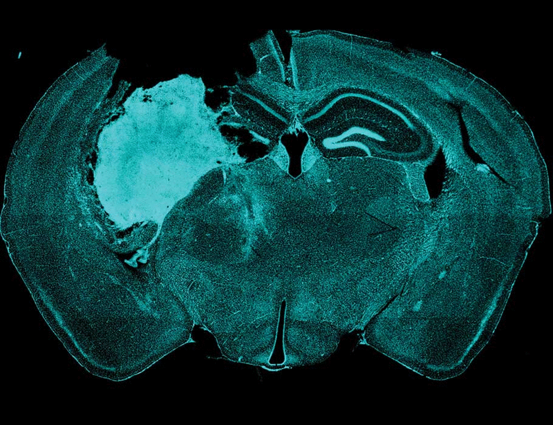Researchers have engineered living tumor cells to secrete interferon beta (IFNB) and granulocyte-macrophage colony-stimulating factor (GM-CSF) to both target tumors and alter the tumor microenvironments. 