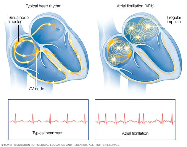 A growing body of evidence supports more aggressive rhythm control with ablation, whether earlier in a patient's AFib diagnosis to achieve better long-term outcomes. 
