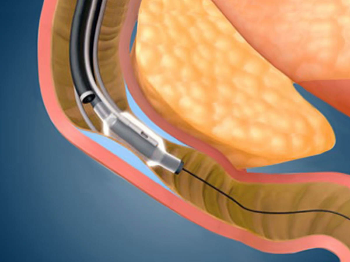 Duodenal mucosal resurfacing (DMR) is a novel endoscopic procedure that aims to achieve metabolic effects by intervening on the mucosal surface of the duodenum. The procedure is performed under fluoroscopic and endoscopic guidance by introducing a catheter with a balloon into the duodenum.