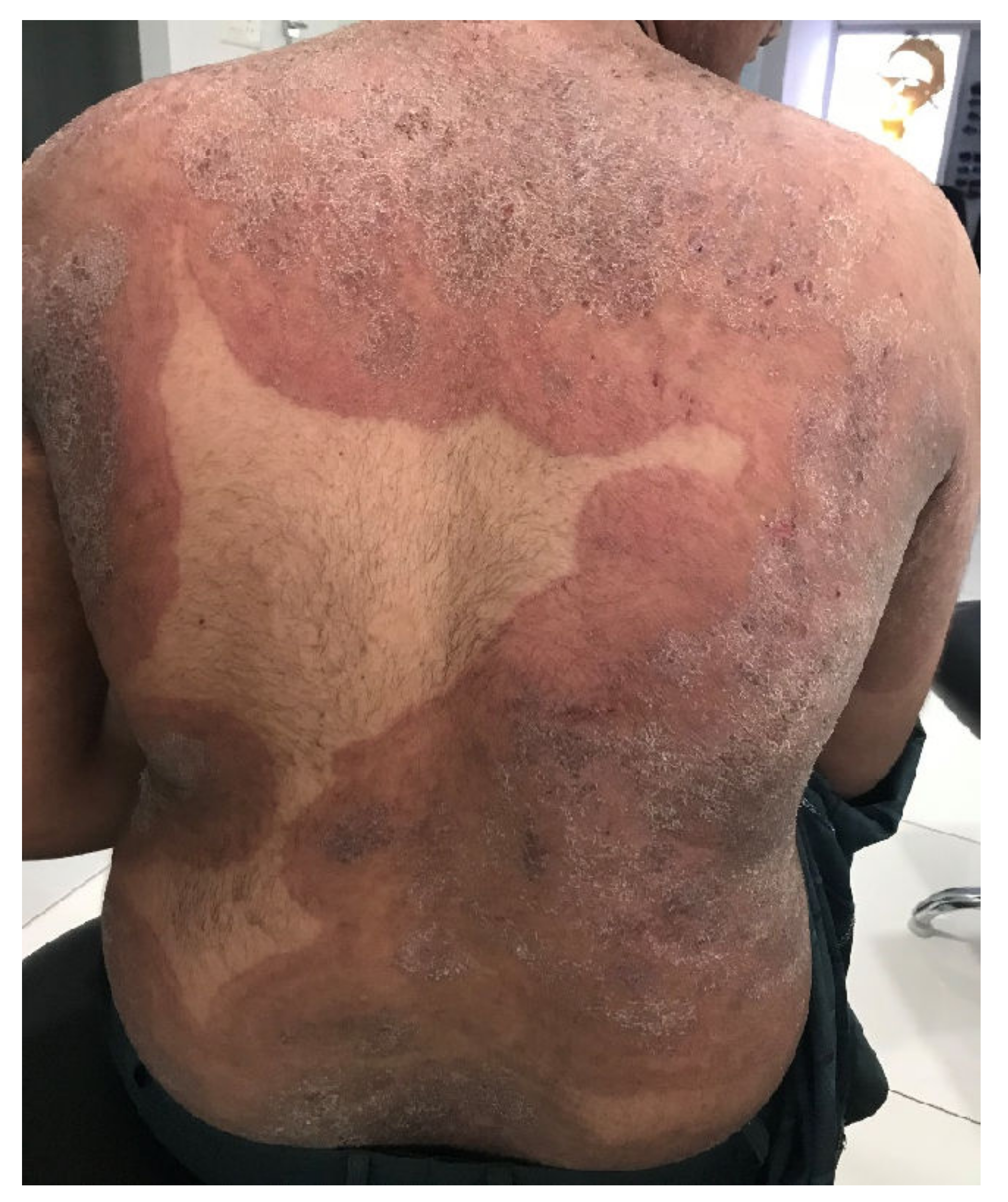 Tinea corporis generalisata in an Indian patient. The itchy erythematosquamous plaques converge over a large area and are sharply limited to the unaffected skin of the environment.