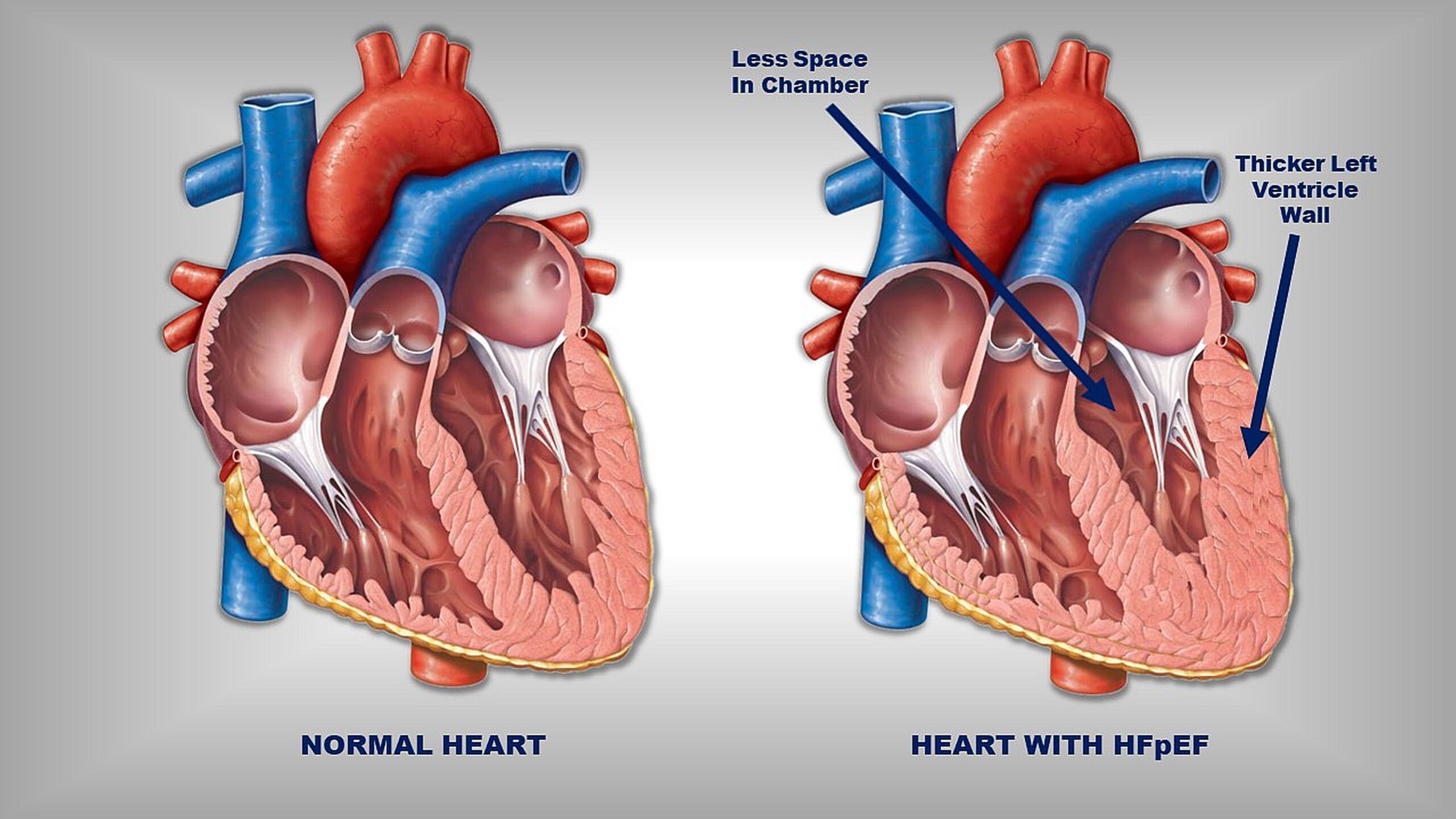 Two hearts, a normal on the left and one with heart failure with preserved ejection fraction (HFpEF) on the right. The heart with HFpEF has a thicker, stiffer left ventricular wall and therefore, less room in the ventricle chamber to fill with an adequate amount of blood to be pumped around the body. A Johns Hopkins Medicine study shows obesity weakens heart muscle in this common form of heart failure.