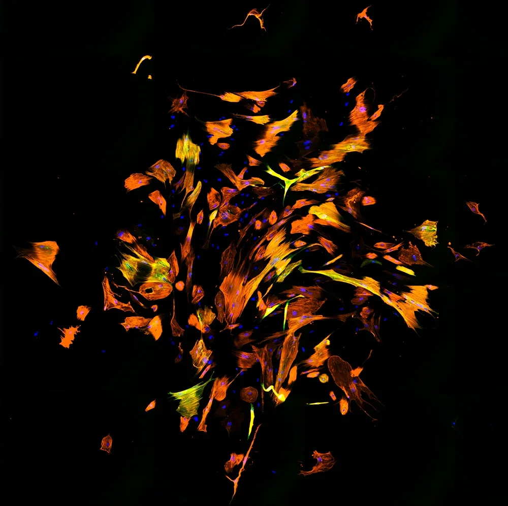 Human fibroblasts reprogrammed into cardiomyocyte-like cells. Immunofluorescence shows different molecules: DNA (blue), cardiac Troponin T (orange) and αActinin (green).