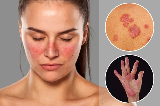 Lupus symptoms tend to vary from person to person, and can include pain and swelling in one or more joints, red spots on the skin, excessive fatigue, skin lesions after sun exposure, hair loss, increased light sensitivity, mouth ulcers and nose ulcers.