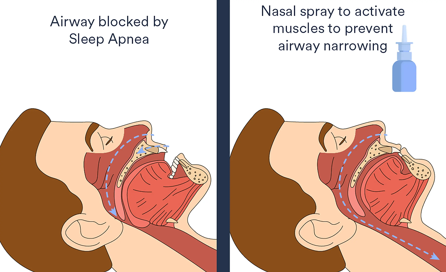 Using a bedtime nasal spray that activates throat muscles can reduce the severity of sleep apnea and lower blood pressure. 