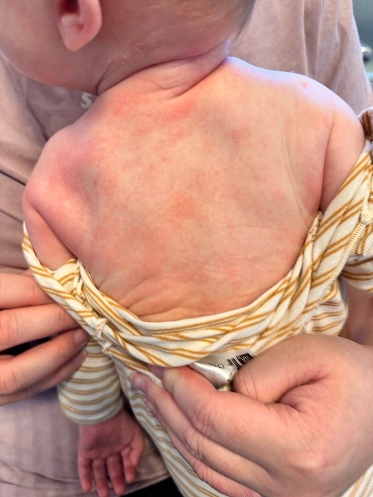 Hunter developed hives after having an allergy reaction to peanut butter.