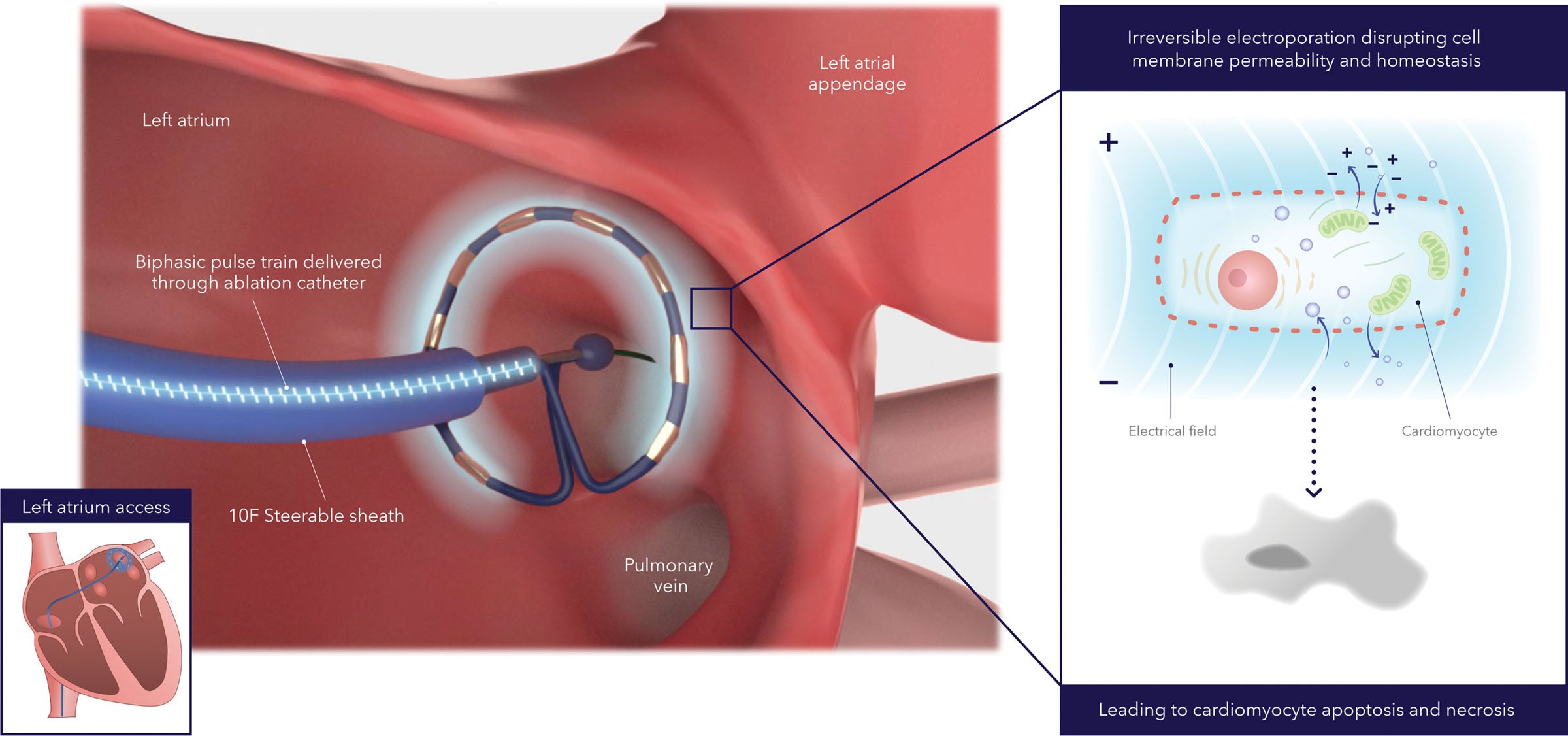 Catheter ablation method with pulsed field ablation system. Alternating positive and negative electrodes sustains a bipolar electrical field around the catheter that extends into the tissue. The electrical field increases cell membrane permeabilization, which then leads to cell function disruption and eventually to cell death (ie, apoptosis and necrosis).