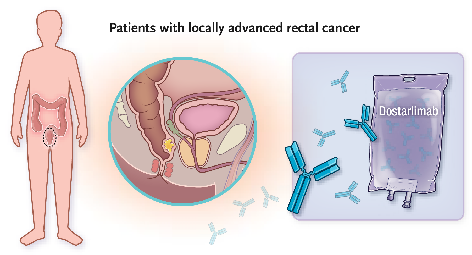 Research suggests that immune checkpoint blockade alone is highly effective in patients with mismatch repair–deficient metastatic colorectal cancer