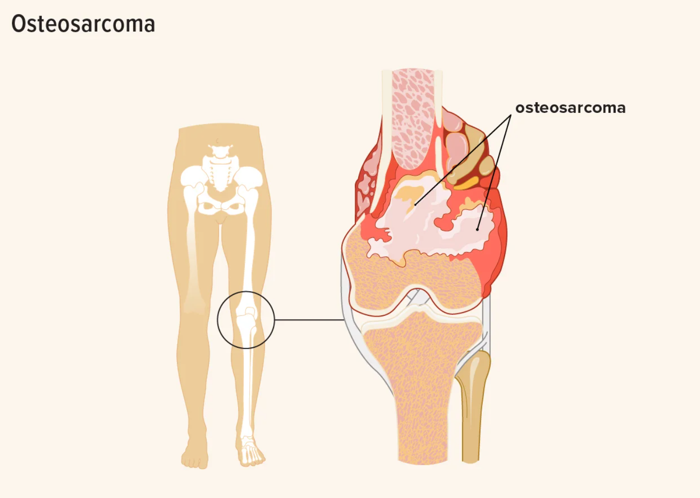 Studies have yielded encouraging results: bioactive glass doped with gallium eliminated 99% of osteosarcoma (bone cancer) cells in laboratory tests