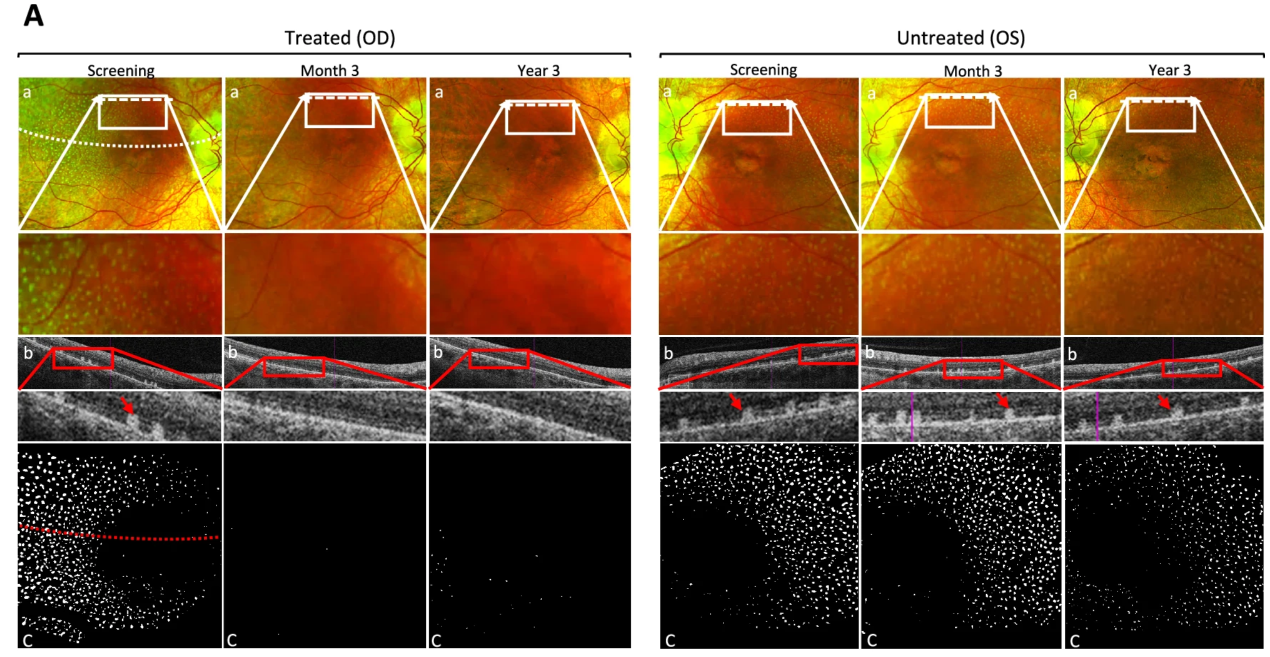 Punctata albescens deposit in patient C2.C is present in both eyes on color fundus photos at the screening visit.