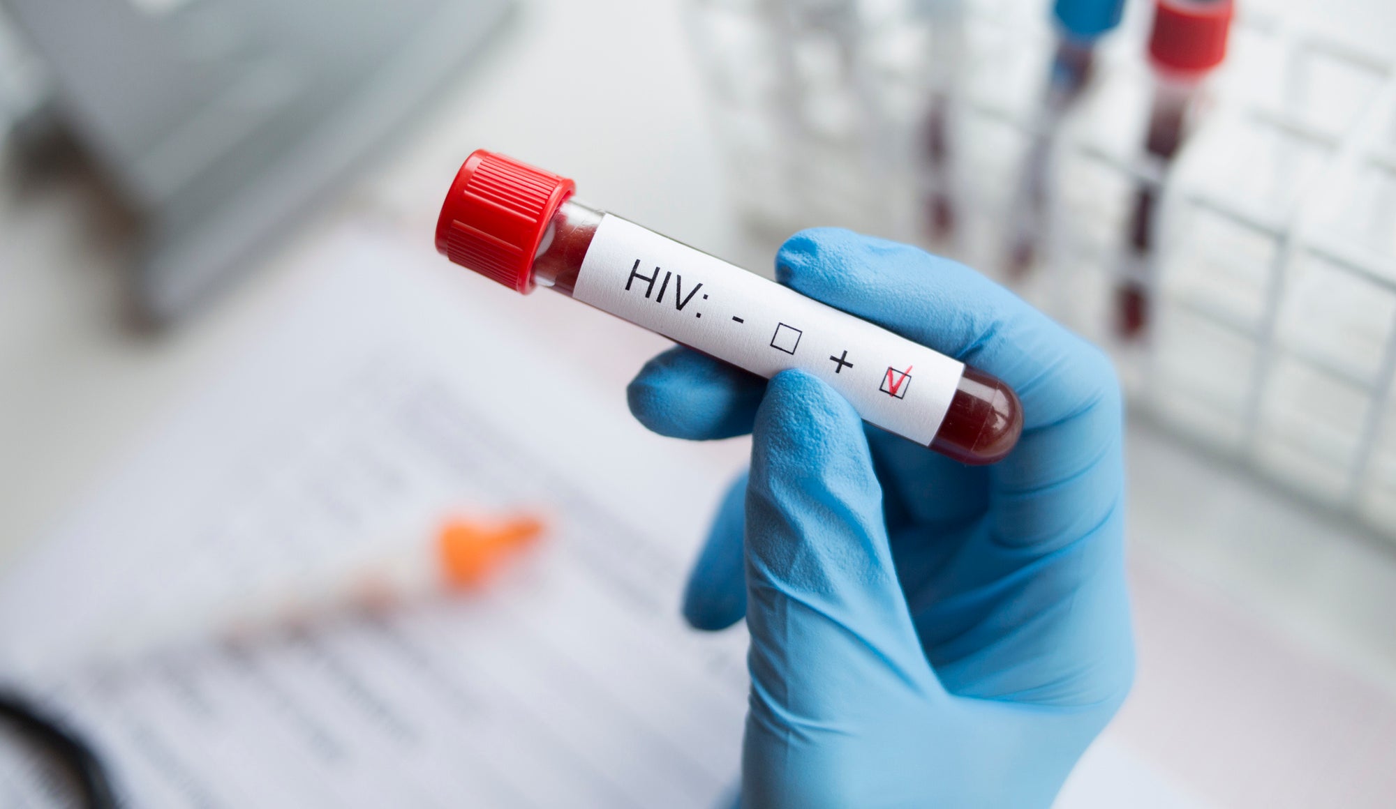 AIDS patient cured of HIV after receiving a bone marrow transplant