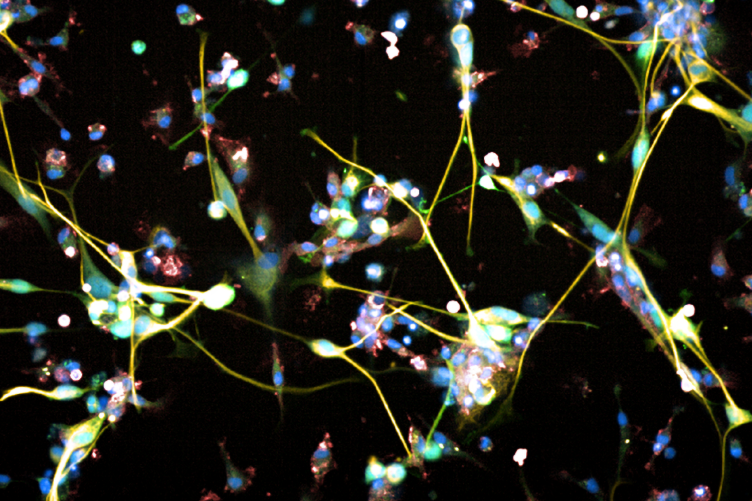 Glioblastoma cells under the microscope.