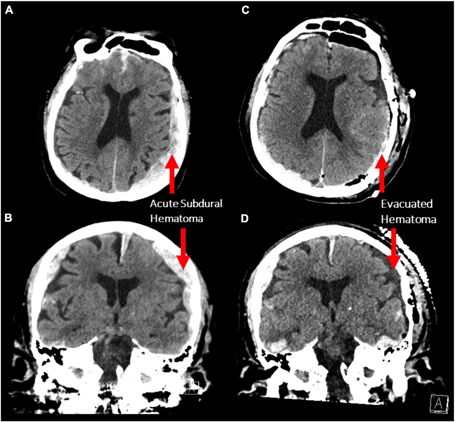 Axial and coronal non-contrast CT scans demonstrating bilateral acute subdural hematoma with a larger mass effect on the left side (maximum thickness 1.5 cm). The same scan sequences after decompressive craniotomy demonstrating evacuation of the left subdural hematoma.