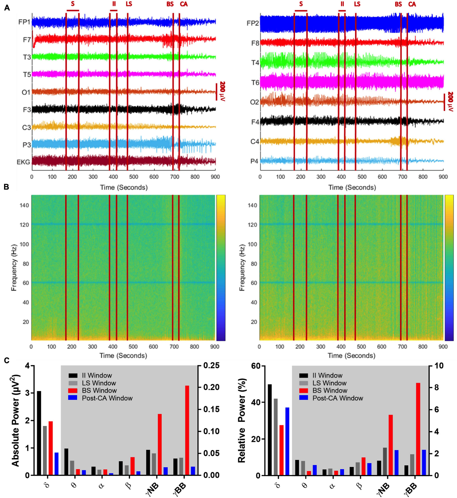 Global EEG output from the 10–20 system with concurrent EKG signal over a 900 s period encompassing a seizure (S), suppression of left cerebral hemisphere activity (LS), suppression of bilateral cerebral hemisphere activity (BS), and cardiac arrest (CA). Left panel indicates left brain hemisphere, right panel indicates right brain hemisphere. 