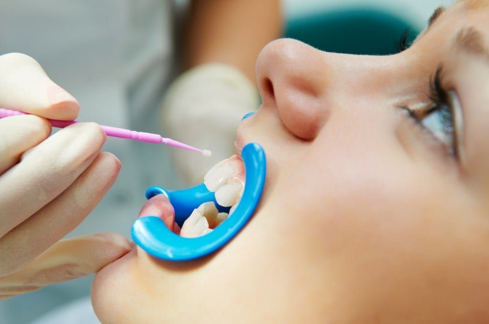 Unlike traditional dental sealants, which require a dentist or dental hygienist, SDF can be applied by a dental nurse.