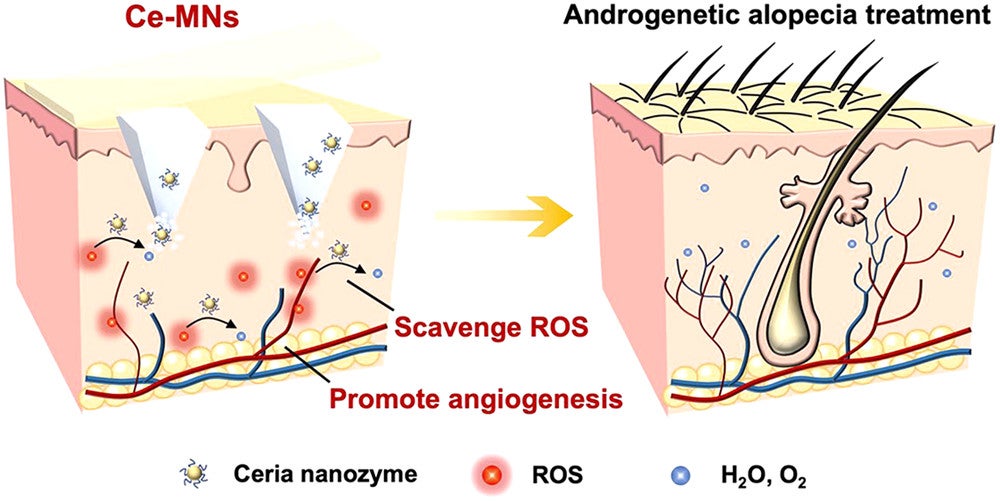 Abstract: The dysregulation of the hair follicle niche induced by excessive reactive oxygen species (ROS) and insufficient vascularization in the perifollicular microenvironment is the leading cause of AGA. 