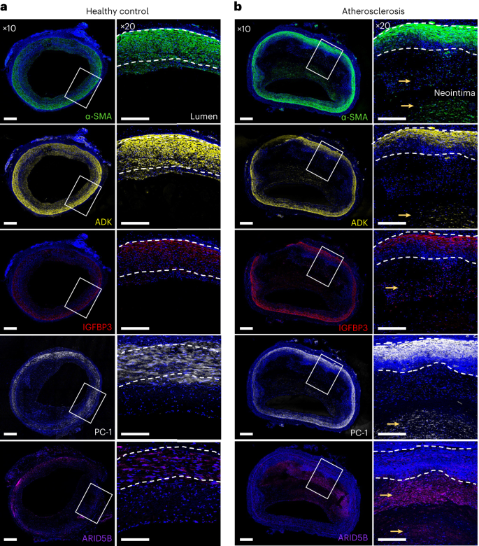 Immunofluorescence staining showing localization of ENPP1, IGFBP3, ARID5B and ADK in control and atherosclerotic human coronary arteries.
