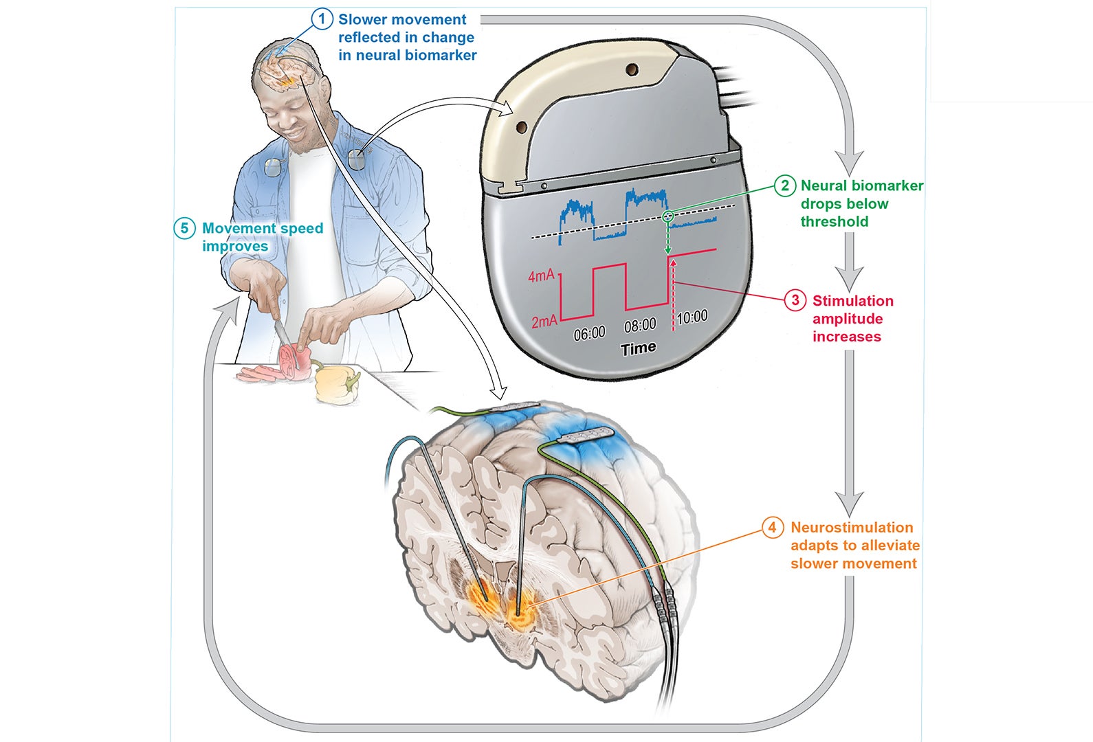 This innovative approach leverages artificial intelligence (AI) to continuously monitor brain activity and adjust treatment in real time.