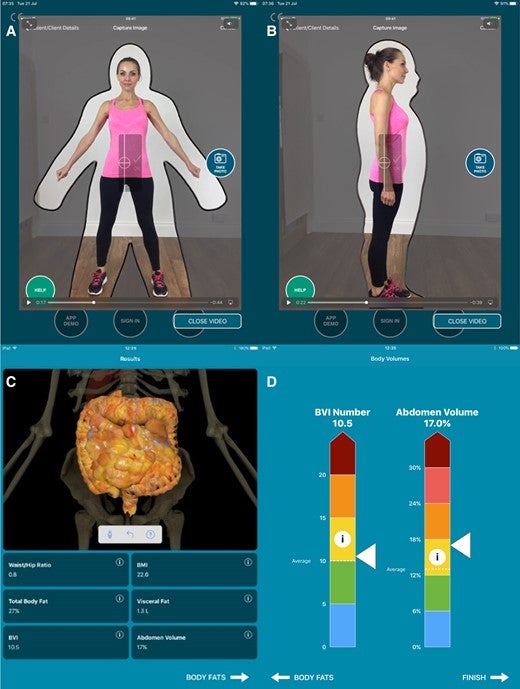 (A) Front-facing and (B) side-facing images taken by the myBVI® mobile application. (C and D) myBVI® application results.