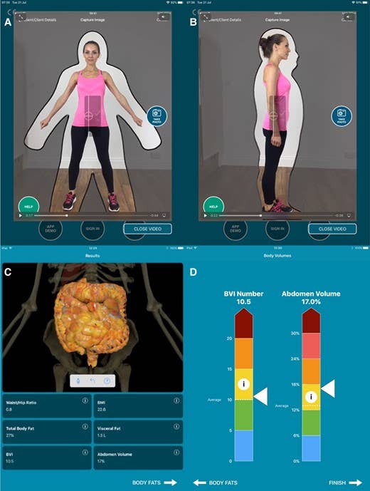 3D body scanner breakthrough uses AI to predict metabolic risk - The ...
