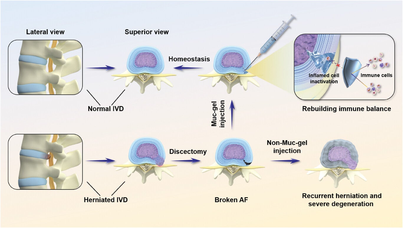 The in situ gelling Muc-gels intervention following discectomy prevent IVD degeneration. The introduction of “clickable” functionality onto mucins are achieved by reacting amine-tetrazine (Tz) or amine-norbornene (Nb) with activated carboxylic groups found in mucins. 