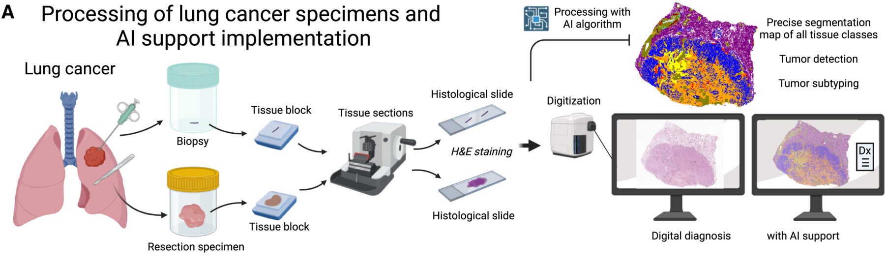 Types of lung cancer specimens and principles of processing in pathology department. Digital pathology allows for diagnostic sign out of cases on the computer monitor and broad application of supportive AI-based tools for automatized slide analysis.