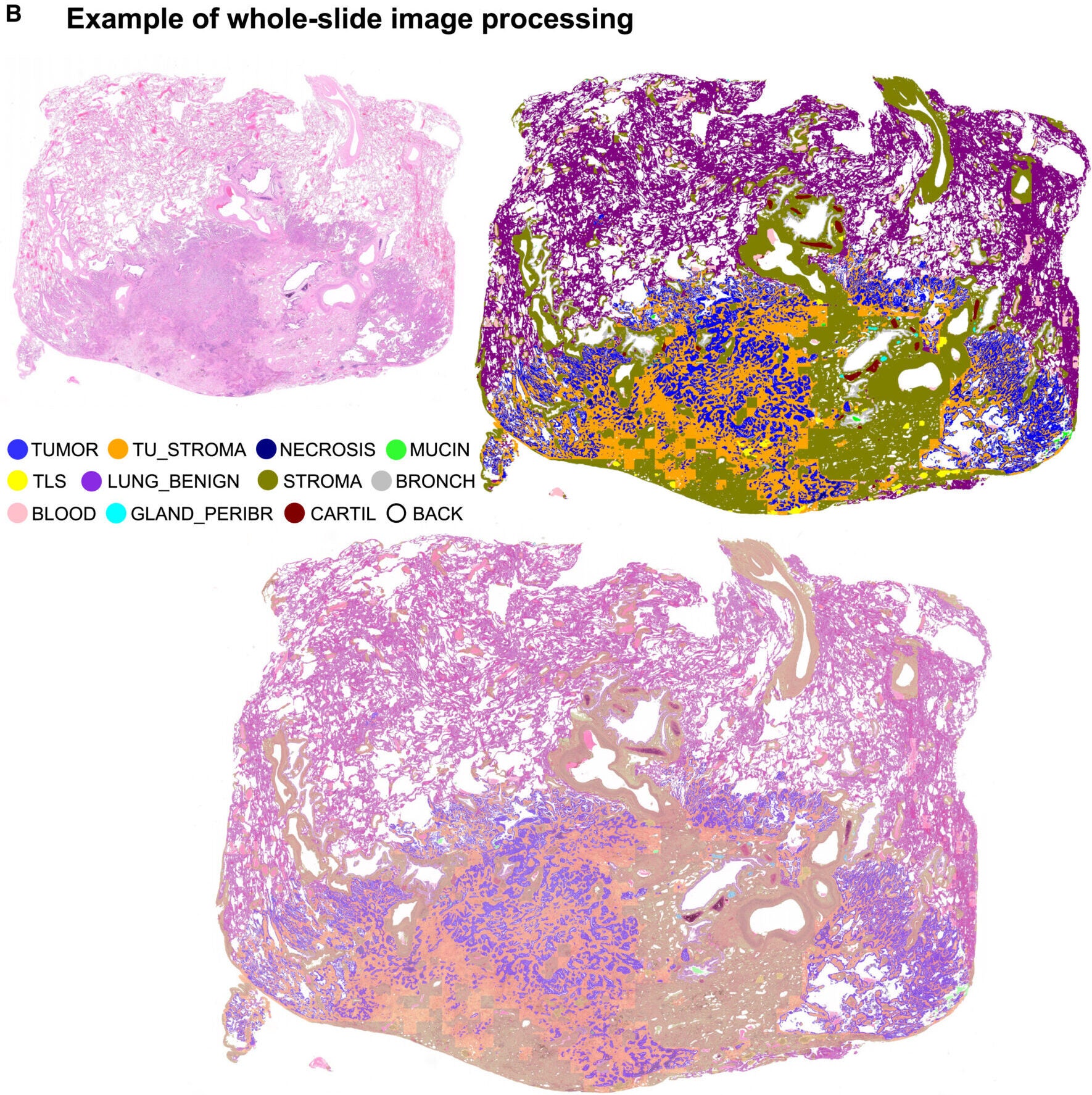 Example of processing of whole-slide image of lung adenocarcinoma (KAM RES cohort) showing original image, segmentation mask produced by algorithm, and overlay of the mask on the original image.