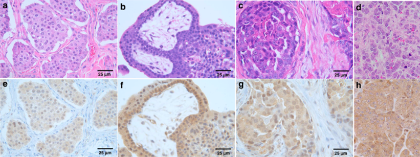 Procaspase-3 (PC-3) expressions in diverse tumour histologies categorised as moderate-to-strong immunostaining intensities. 