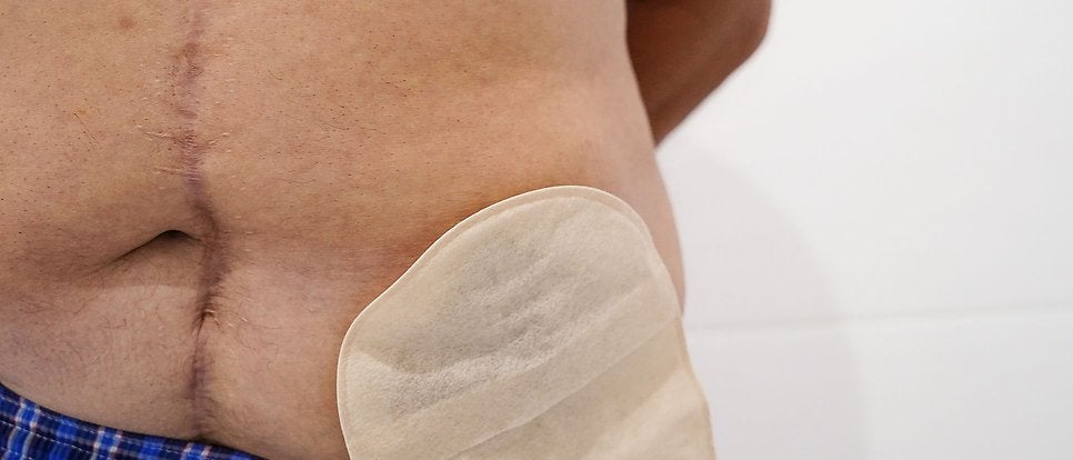 When a person is diagnosed with rectal cancer, part of the bowel is often removed, which could lead to the need for a stoma. With the new method, surgery can often be avoided. 